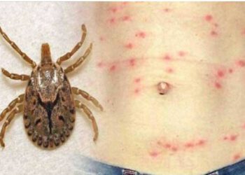 हिमाचल में कोरोना के बीच  स्क्रब टायफस के मामले, अब तक 648…