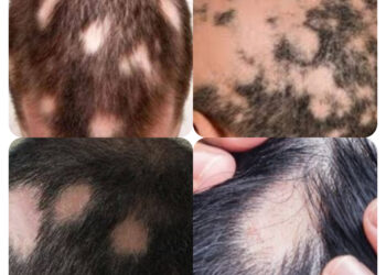बालों में कीड़े लगने से कई लोग परेशान, लेकिन डरने की बात नहीं, इसका उपचार है संभव, जानिए…..