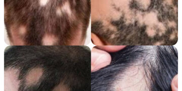 बालों में कीड़े लगने से कई लोग परेशान, लेकिन डरने की बात नहीं, इसका उपचार है संभव, जानिए…..