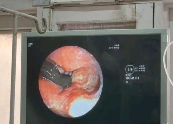 शिमला के आईजीएमसी में अनोखा मामला, मरीज के गले से निकाली गई जीवित जोंक