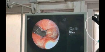 शिमला के आईजीएमसी में अनोखा मामला, मरीज के गले से निकाली गई जीवित जोंक